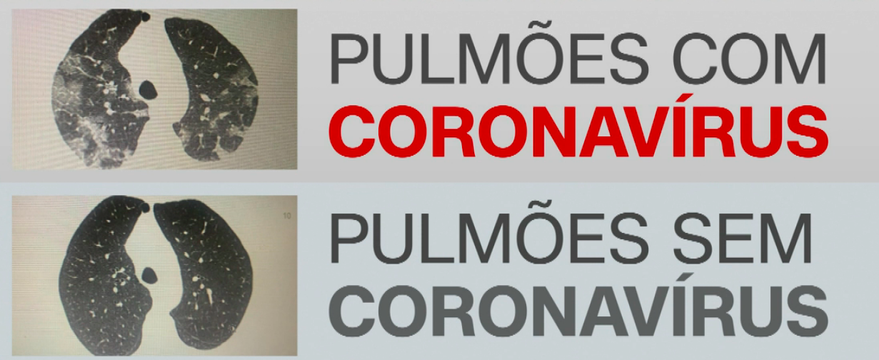 Imagem de pulmões revela evolução do coronavírus