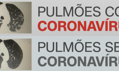 Tomografia revela evolução do coronavírus em pulmões; veja antes e depois