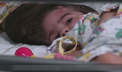 Gêmeas siamesas são separadas após 3 cirurgias; médico explica procedimento