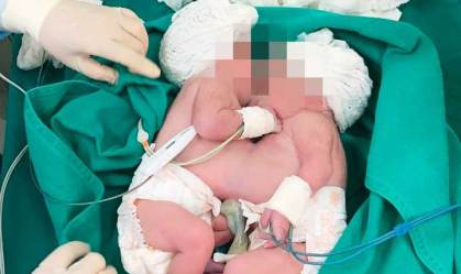 Jovem de 18 anos dá à luz gêmeas siamesas na Bahia