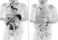 Não só Covid-19, mas qualquer infecção pode estimular corpo a combater câncer