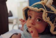 Desnutrição aguda ameaça a vida de milhões de crianças vulneráveis, alerta a ONU