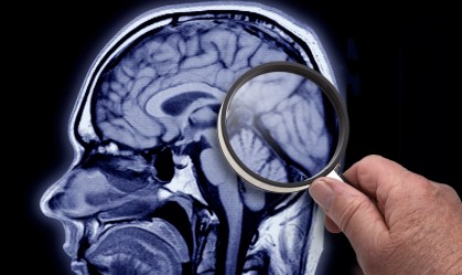 Medidas preventivas podem retardar o desenvolvimento do Alzheimer