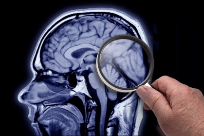 Medidas preventivas podem retardar o desenvolvimento do Alzheimer