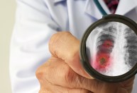 Mortes por tuberculose aumentam pela primeira vez em 10 anos devido à Covid-19