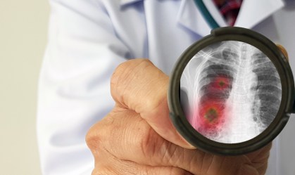 Mortes por tuberculose aumentam pela primeira vez em 10 anos devido à Covid-19