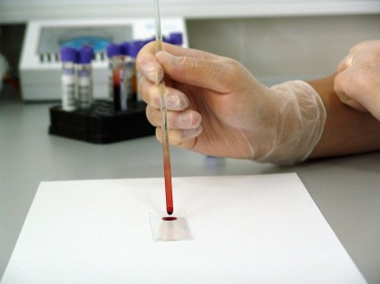Sangue é analisado em laboratório