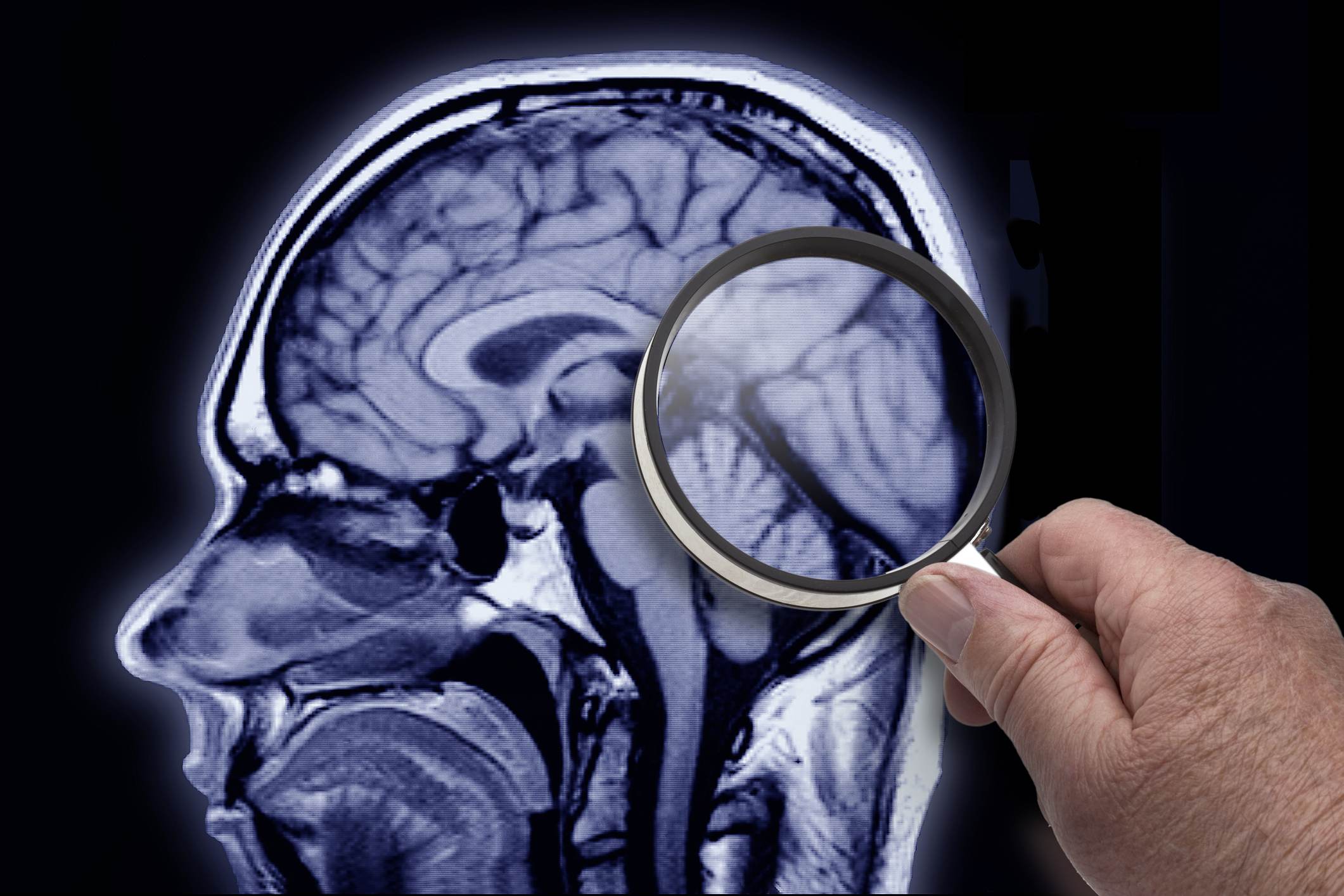 Medidas preventivas podem retardar o desenvolvimento do Alzheimer