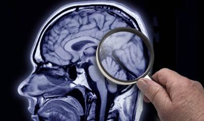 Medidas preventivas podem retardar o desenvolvimento do Alzheimer
