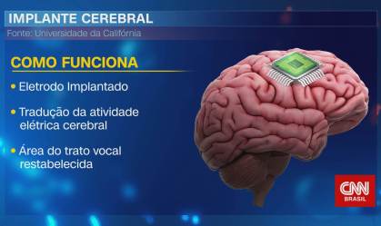 Homem que sofreu AVC usa computador para se comunicar após implante cerebral