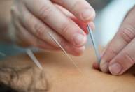 Medo de agulha? Técnicas prometem efeito semelhante à acupuntura sem perfuração