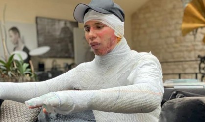 Diretor de grife francesa revela que ficou gravemente ferido após explosão