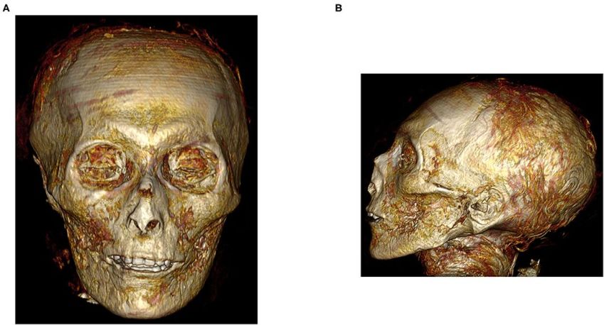 Crânio do faraó Amenhotep I com dentes em excelentes condições / Frontiers in Medicine