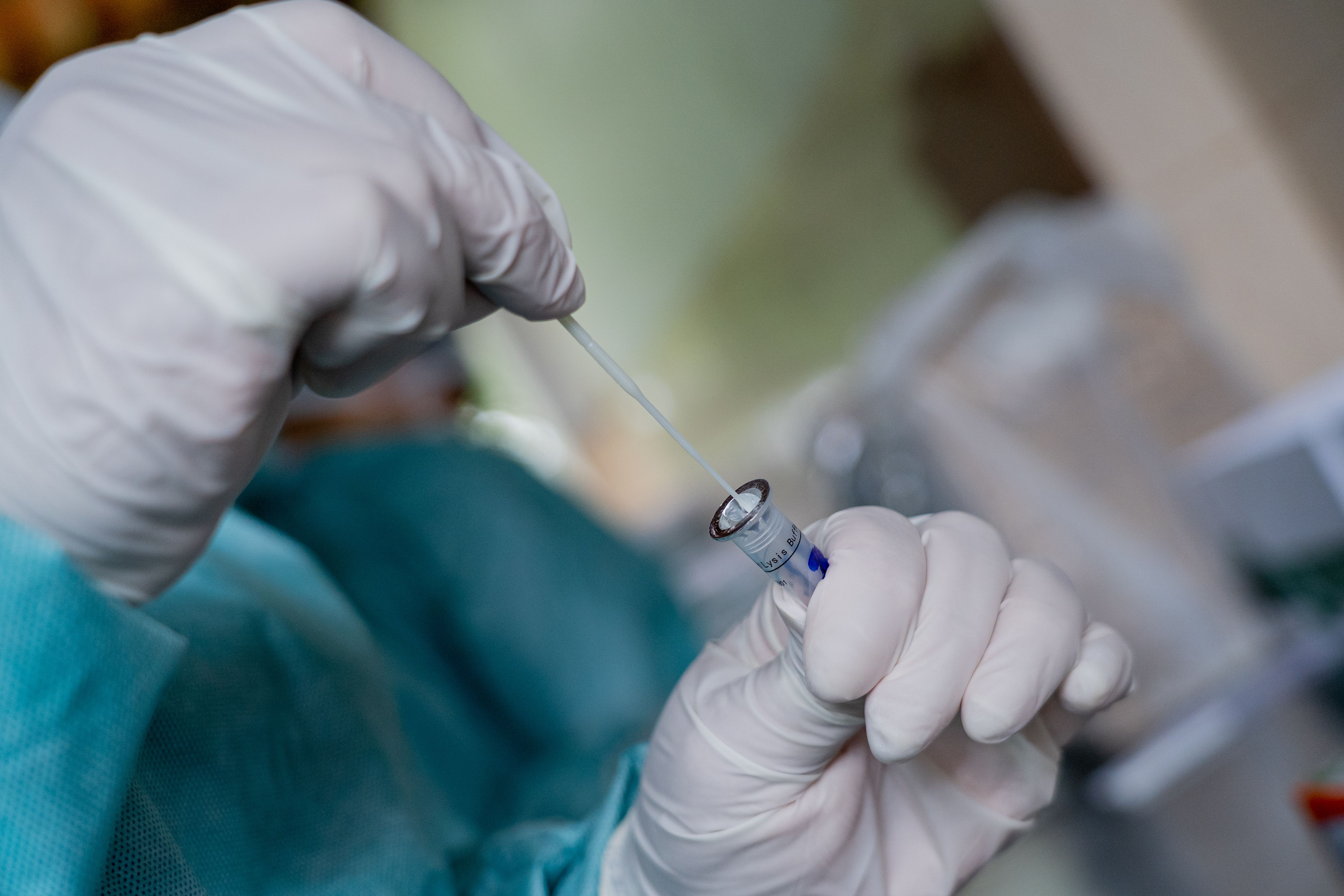 Teste rápido swab nasal para detecção de Covid-19 | coronavírus | testagem | exame | diagnóstico | pandemia | coronavírus | saúde