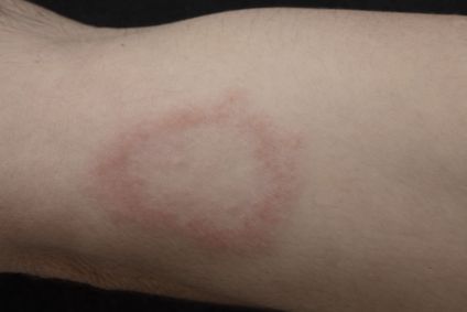 Hanseníase pode provocar lesões graves na pele e nos nervos