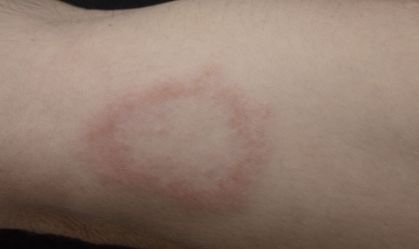 Hanseníase: veja sintomas e diagnóstico da doença que tem vacina em estudo