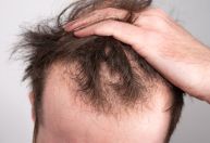 Pesquisa elenca melhores tratamentos para queda de cabelo masculino