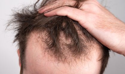 Pesquisa elenca melhores tratamentos para queda de cabelo masculino