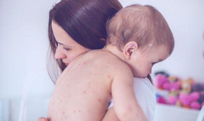 Sarampo: conheça os riscos, sintomas e tratamento da doença