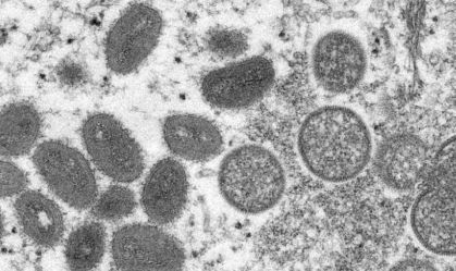 Após Europa, Estados Unidos confirmam primeiro caso de "varíola dos macacos"