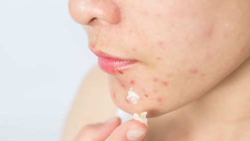 Bactéria foi projetada para produzir proteína que combate a acne na pele