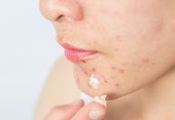 Acne: Qual influência a alimentação tem para a pele?