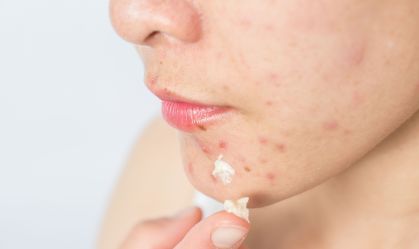 Acne: cientistas projetam "bactérias inteligentes” para tratar doença