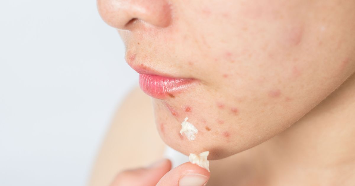 Acnes na adolescência: por que elas surgem e como lidar com elas