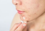 Acne, manchas e irritações: como o uso de máscara afetou a nossa pele