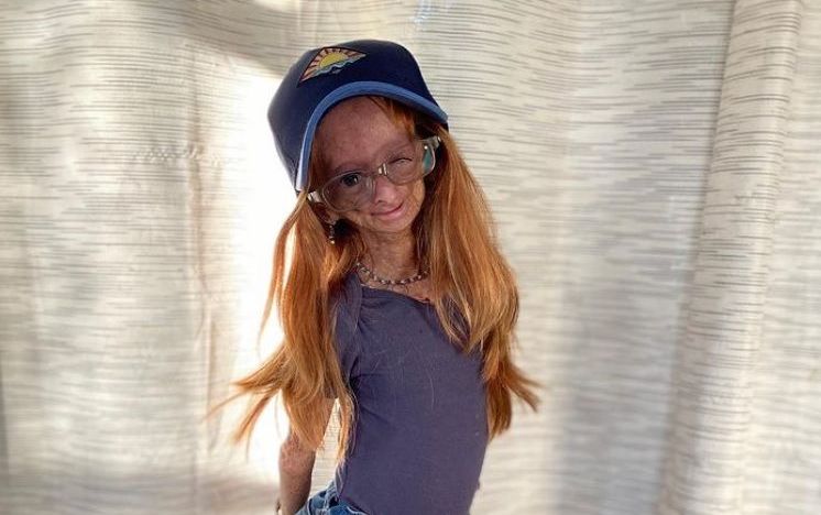 Adalia Rose buscou reduzir o estigma associado à progeria / Reprodução/Instagram