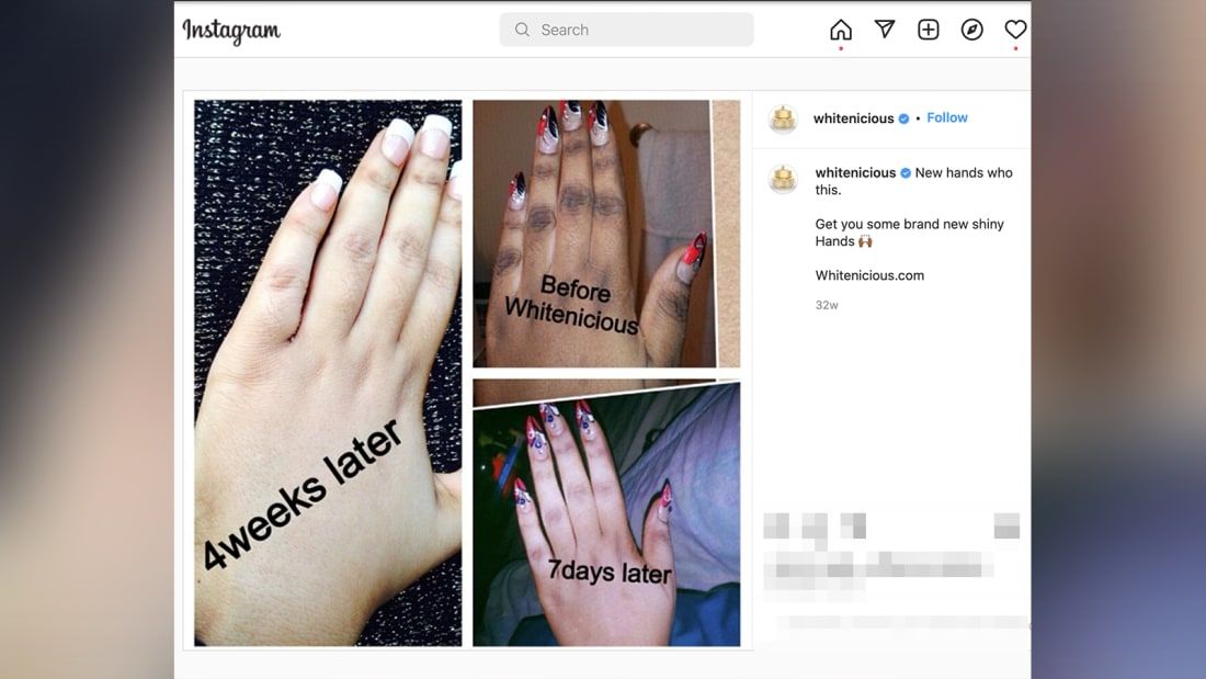 Um post do Instagram anunciando um processo de clareamento da pele. A CNN borrou parte desta imagem para proteger a privacidade de partes não relacionadas. / Reprodução / Instagram