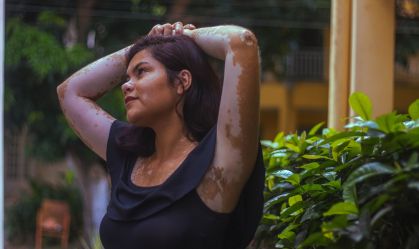 Dia Mundial do Vitiligo: conheça os sintomas, tratamento e impactos da doença