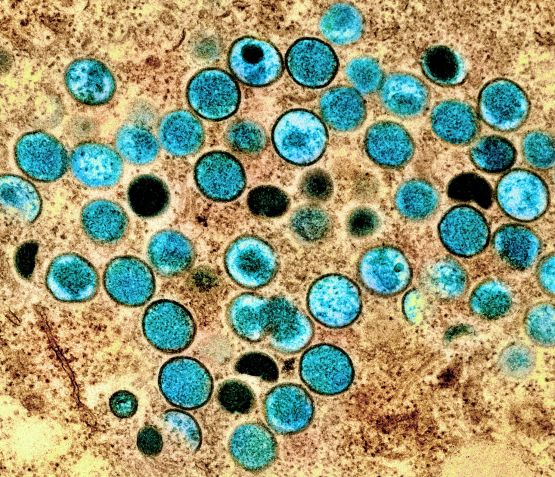 Imagem de microscopia do vírus Monkeypox, que causa a varíola dos macacos / National Institute of Allergy and Infectious Diseases (NIAID)