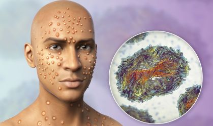 Mpox: o que é mito e o que é verdade segundo especialistas