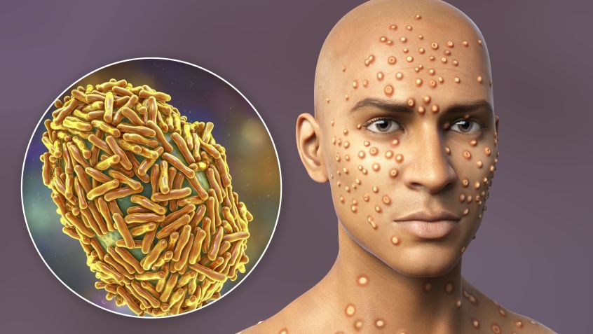Mpox provoca lesões de pele / Kateryna Kon/Sciense Photo Library/Getty Images