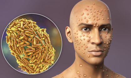 Mpox: como saber se uma lesão de pele pode ser sinal da doença