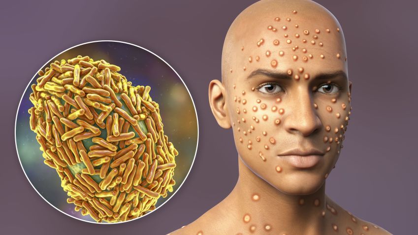 Mpox provoca lesões de pele / Kateryna Kon/Sciense Photo Library/Getty Images