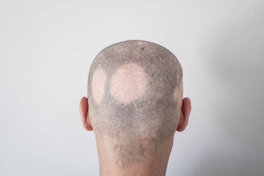 Perda de cabelo focal / Igor Novakovic/Getty Images