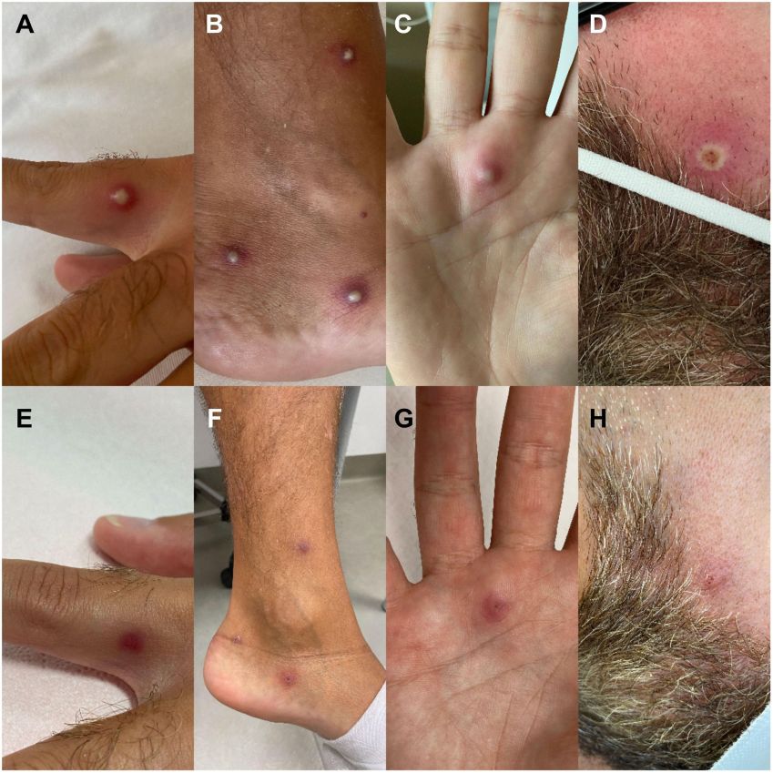 Lesões características do paciente com a varíola dos macacos / Journal of Infection