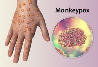 Especialistas apontam principais cuidados com lesões de pele da Monkeypox