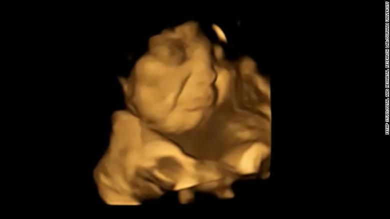 Imagem 4D do mesmo feto mostrando uma reação de choro após ser exposto ao sabor da couve / Fetap Study / Fetal and Neonatal Research Lab / Durham University