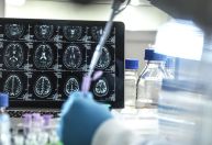 Alzheimer pode ser causado pelo acúmulo de gordura nas células do cérebro