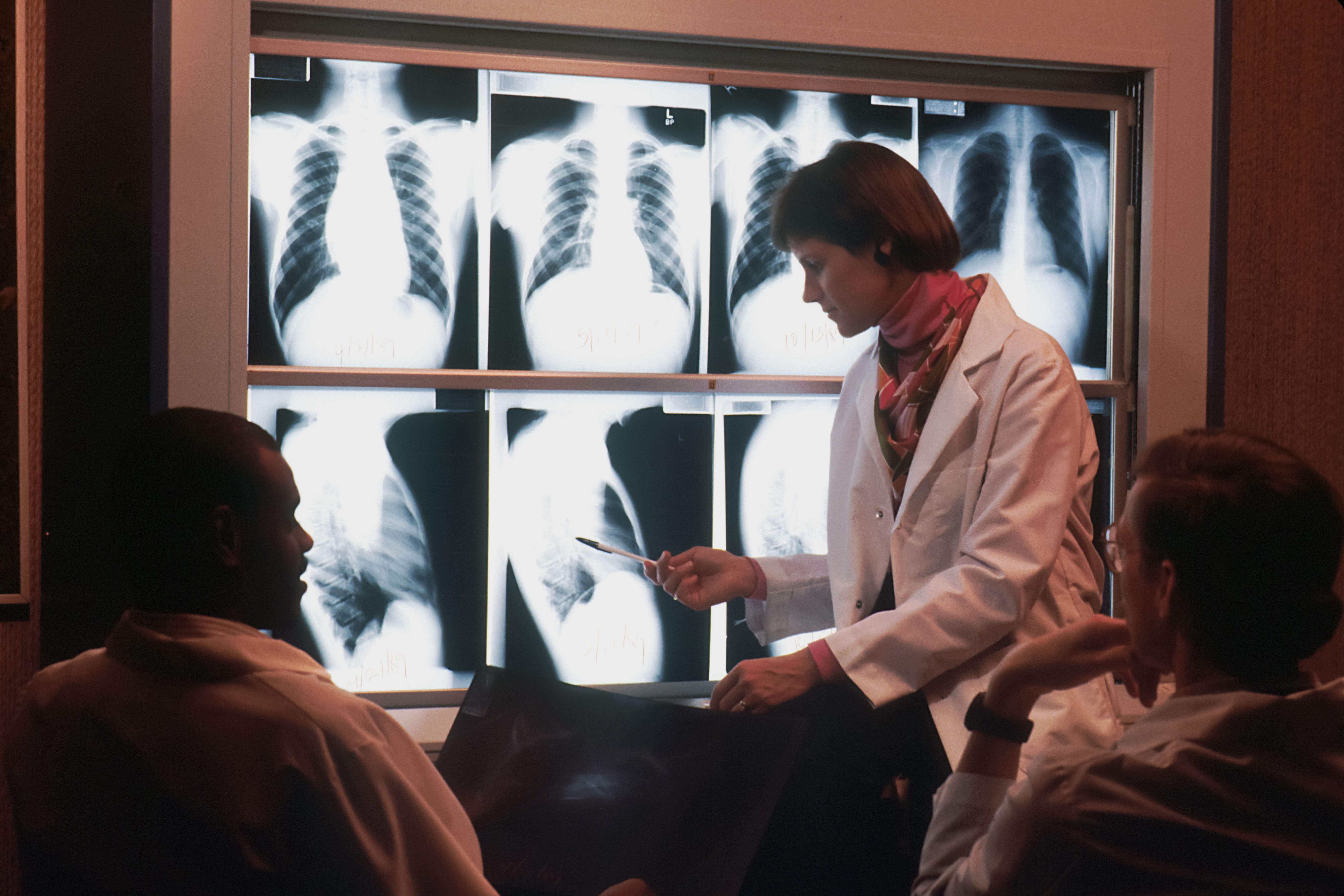 cancer tuberculose pulmão