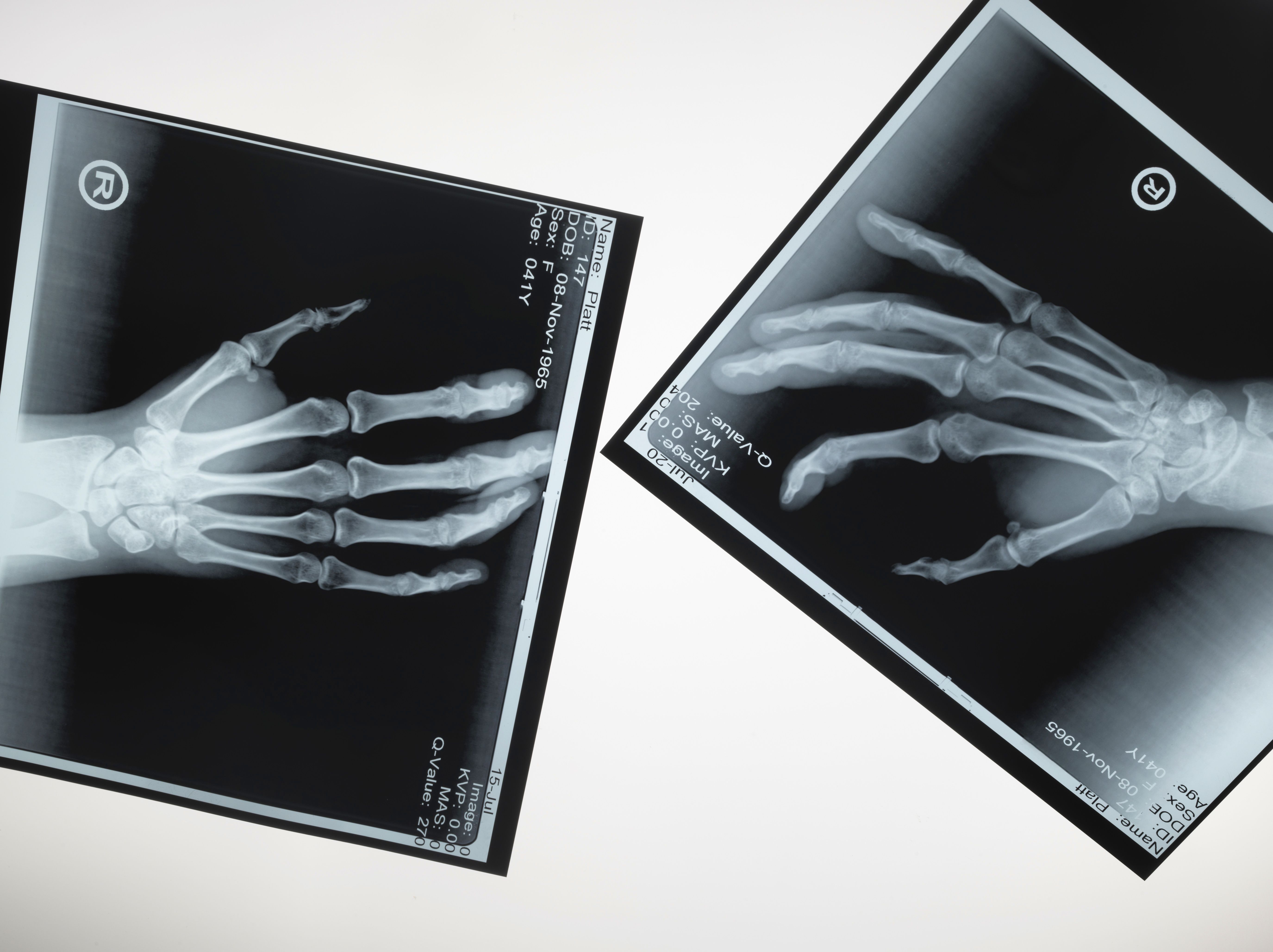 Two x-ray hands reaching out to touch each other