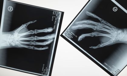 Two x-ray hands reaching out to touch each other