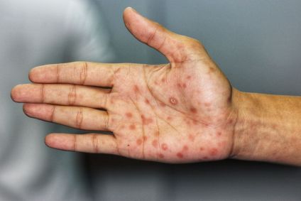 Mão com feridas típicas da sífilis
