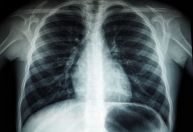 Tuberculose mata 4 mil brasileiros por ano; conheça a doença e os sintomas