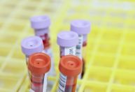 Colesterol alto pode não apresentar sintomas, exame é importante, diz cardiologista