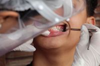 Gengiva sangrando? Dr. Kalil e especialistas detalham sinais de alerta
