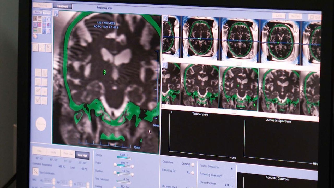 scanner do cerebro